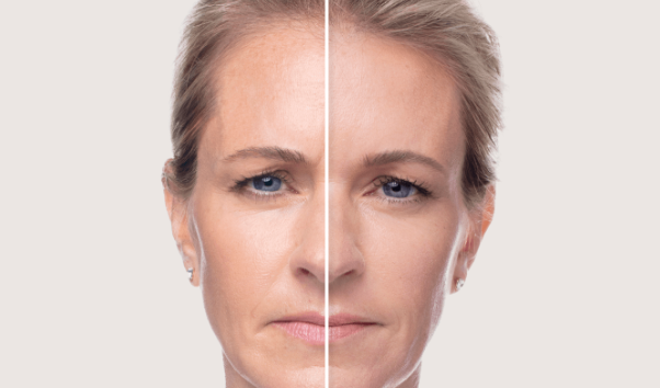 before and after_dysport 4.PNG