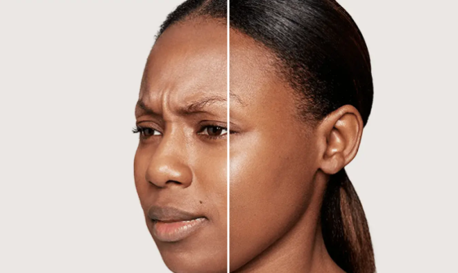 before and after_dysport 2.PNG