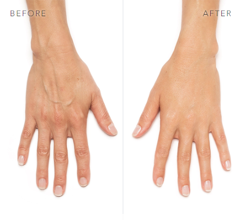 before and after_radiesse 5.PNG