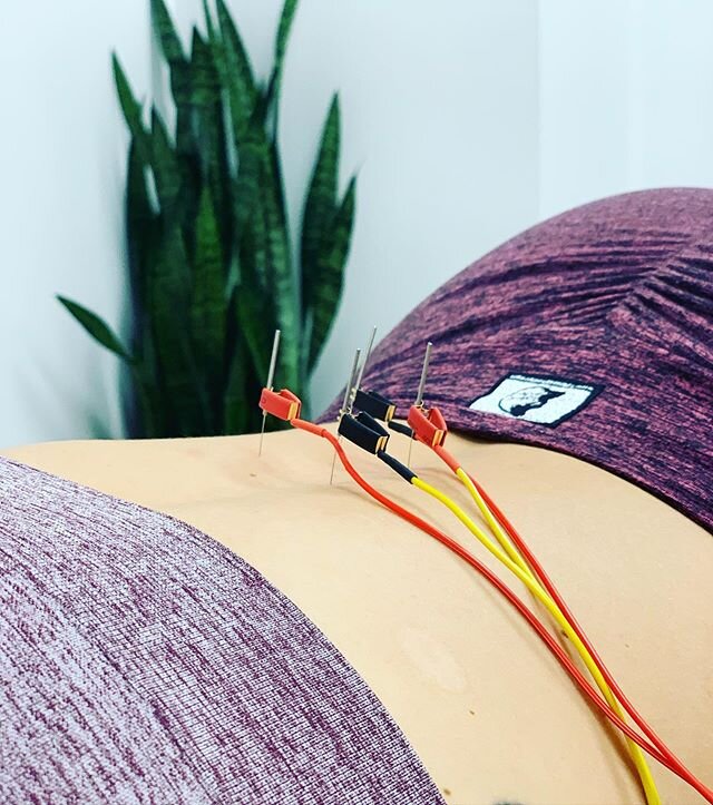 Need some &ldquo;pointers&rdquo; to help you with your &ldquo;current&rdquo; back pain? Try Dry Needling! 👈🏼
.
Myofascial Trigger Point Dry Needling utilizes thin, monofilament needles that are inserted into the skin to treat muscular trigger point