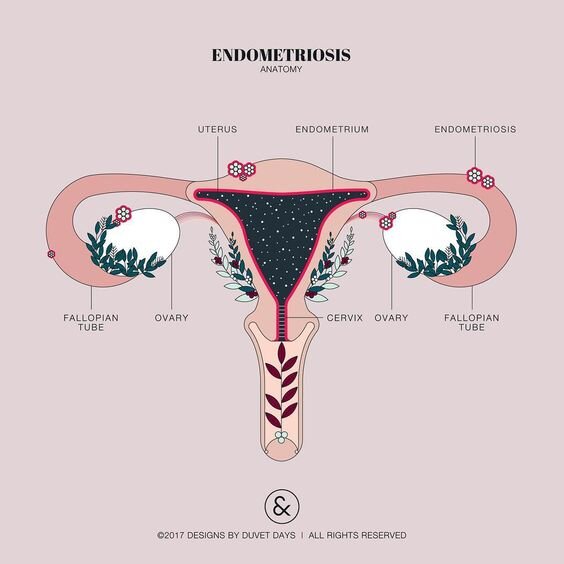 Depiction of endometriosis in a graphic 