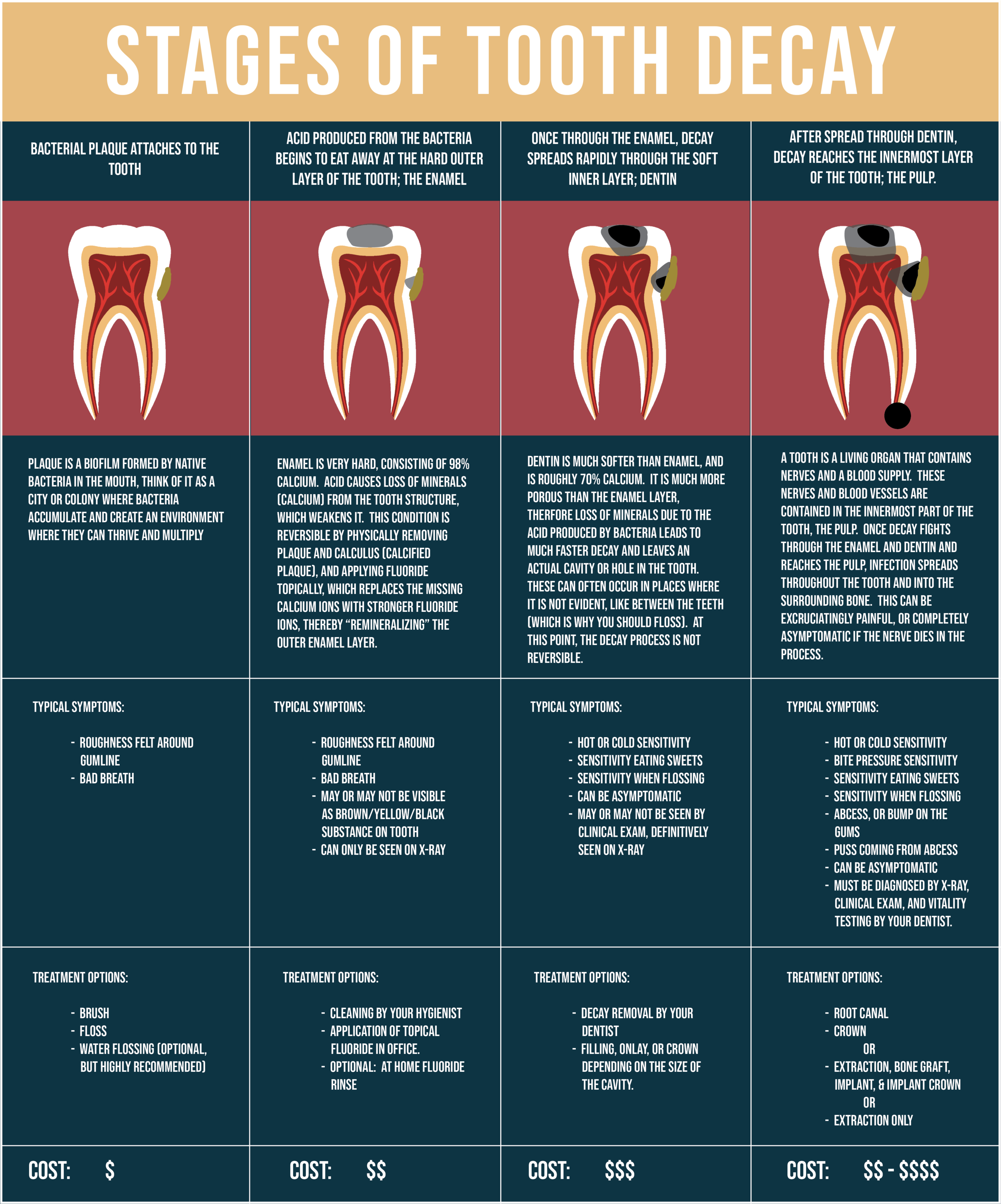 Tooth Decay Diagram Tooth Decay Diagram