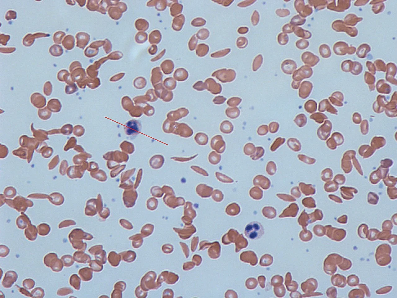 Sickle Cell September