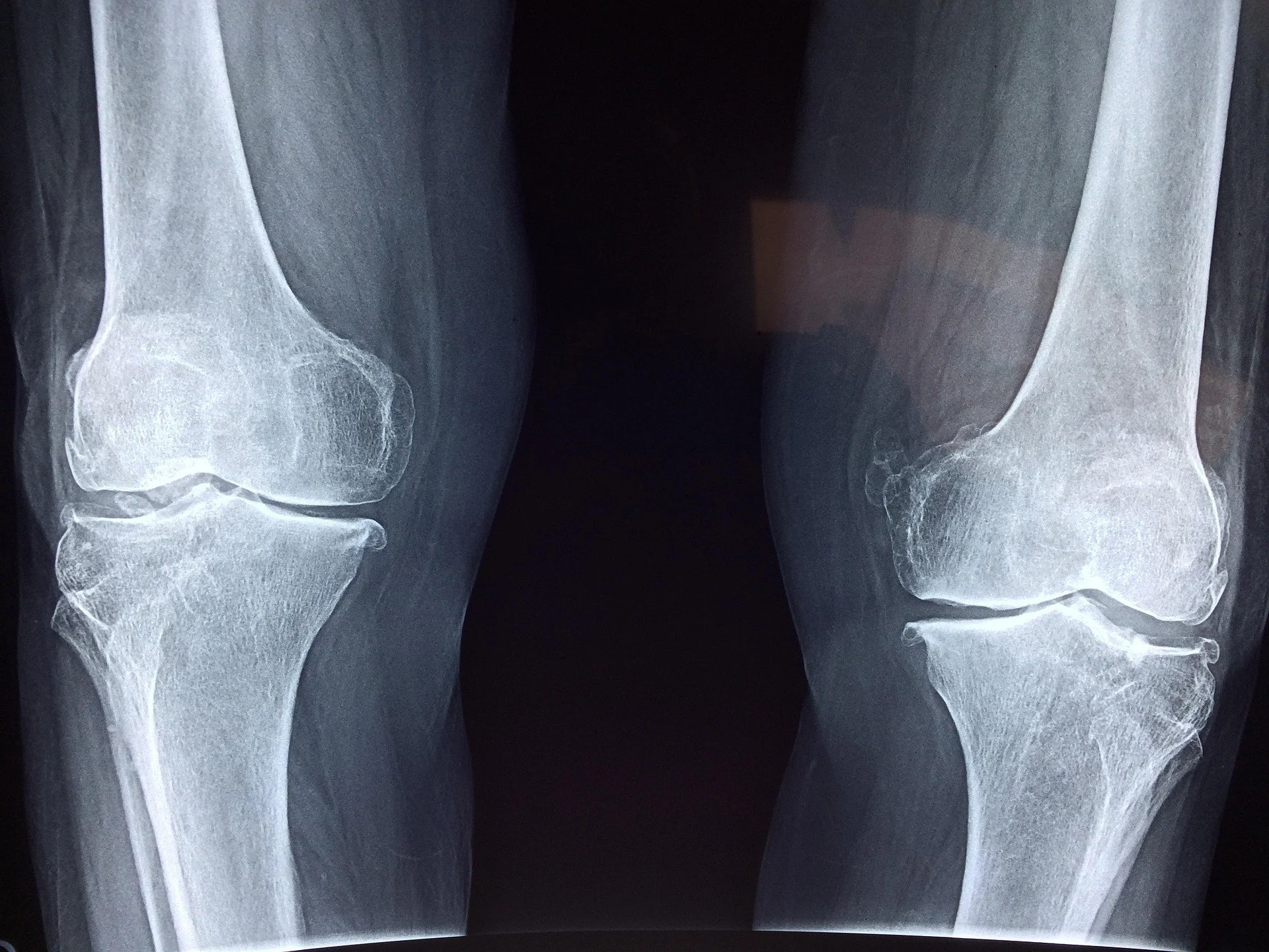 x-ray image of knee joints