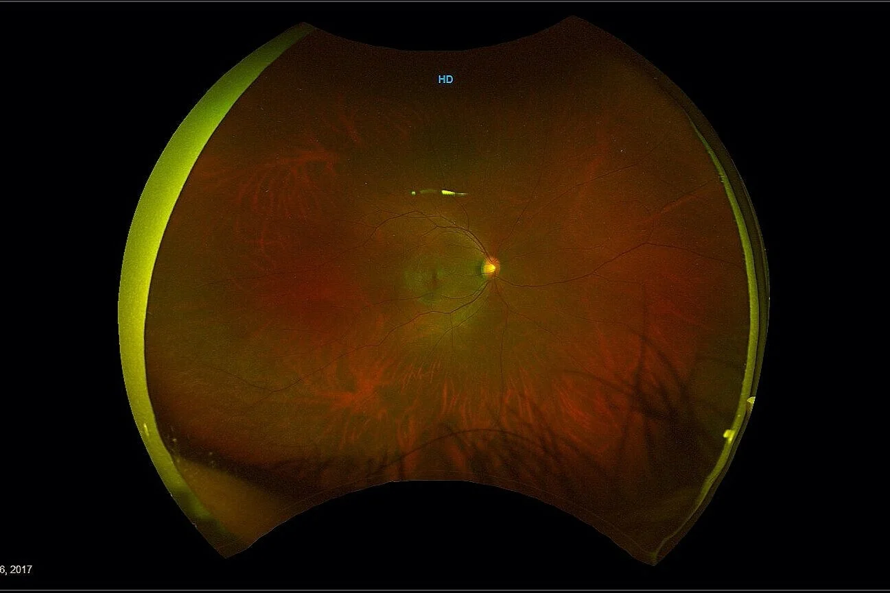 UltraWide Field Color Imaging — University Retina