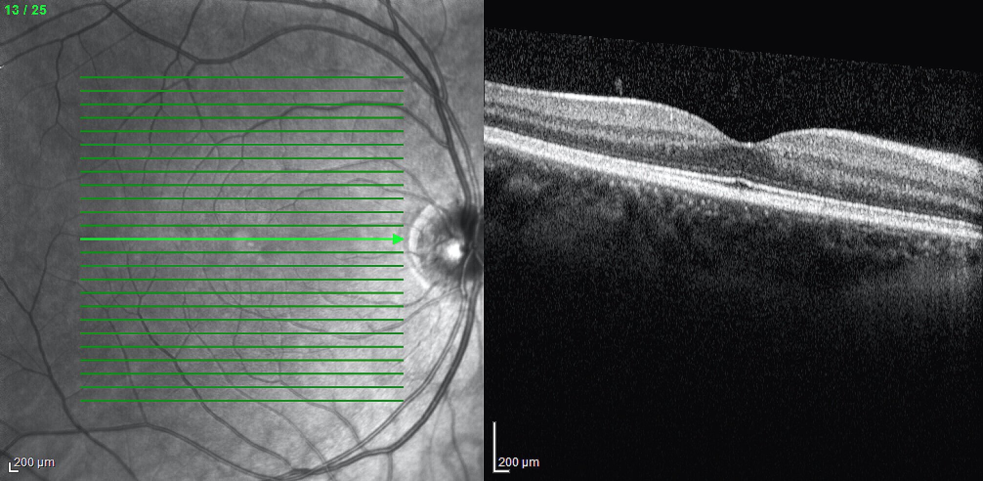 Optical Coherence Tomography Chicago University Retina