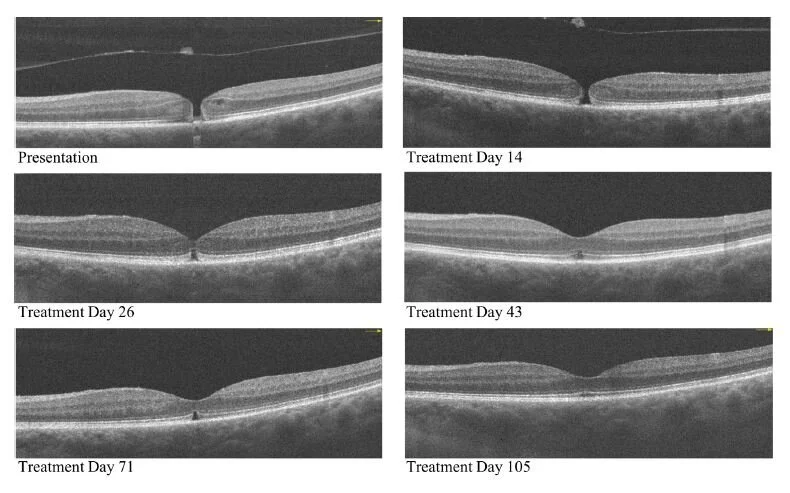 macular hole