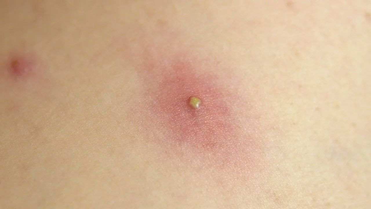 Saddle Sores Bums On The Saddle Sale Bike Saddle Sores Sore Bum From  Cycling Sore From Bike Seat Top