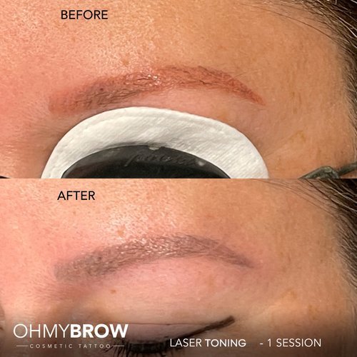 Cosmetic Tattoo Removal — OH MY BROW