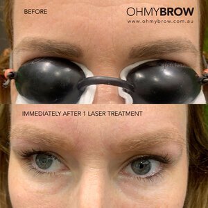 Cosmetic Tattoo Removal — OH MY BROW