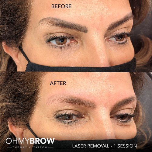 How To Remove Cosmetic Eyebrow Tattoos Safely  Effectively