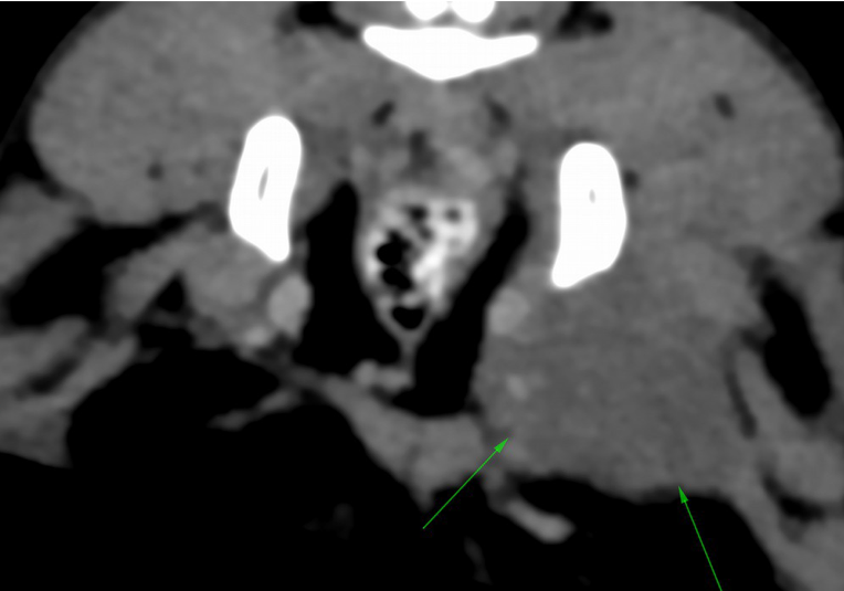 Nitrous’s CT scan before treatment