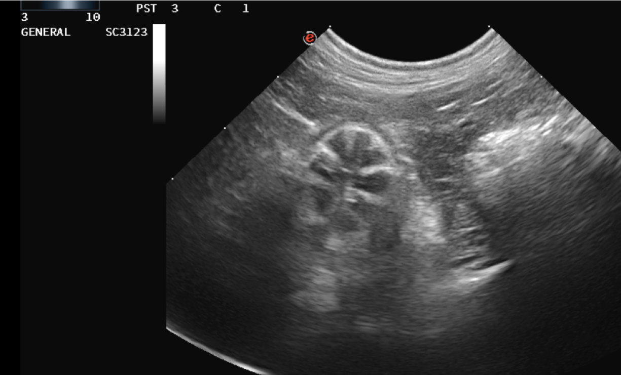 Audrey’s ultrasound after completing chemotherapy