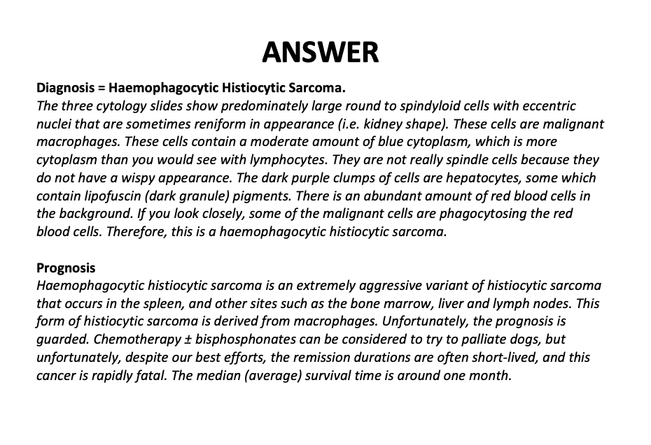 Histiocytic Sarcoma.png