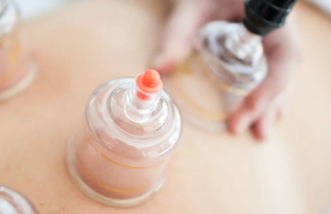 Myofascial Cupping