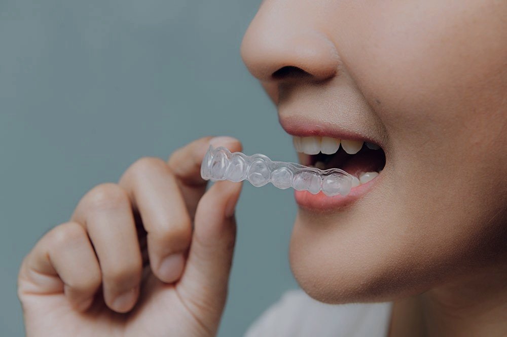what-to-expect-with-your-first-month-of-invisalign.jpg