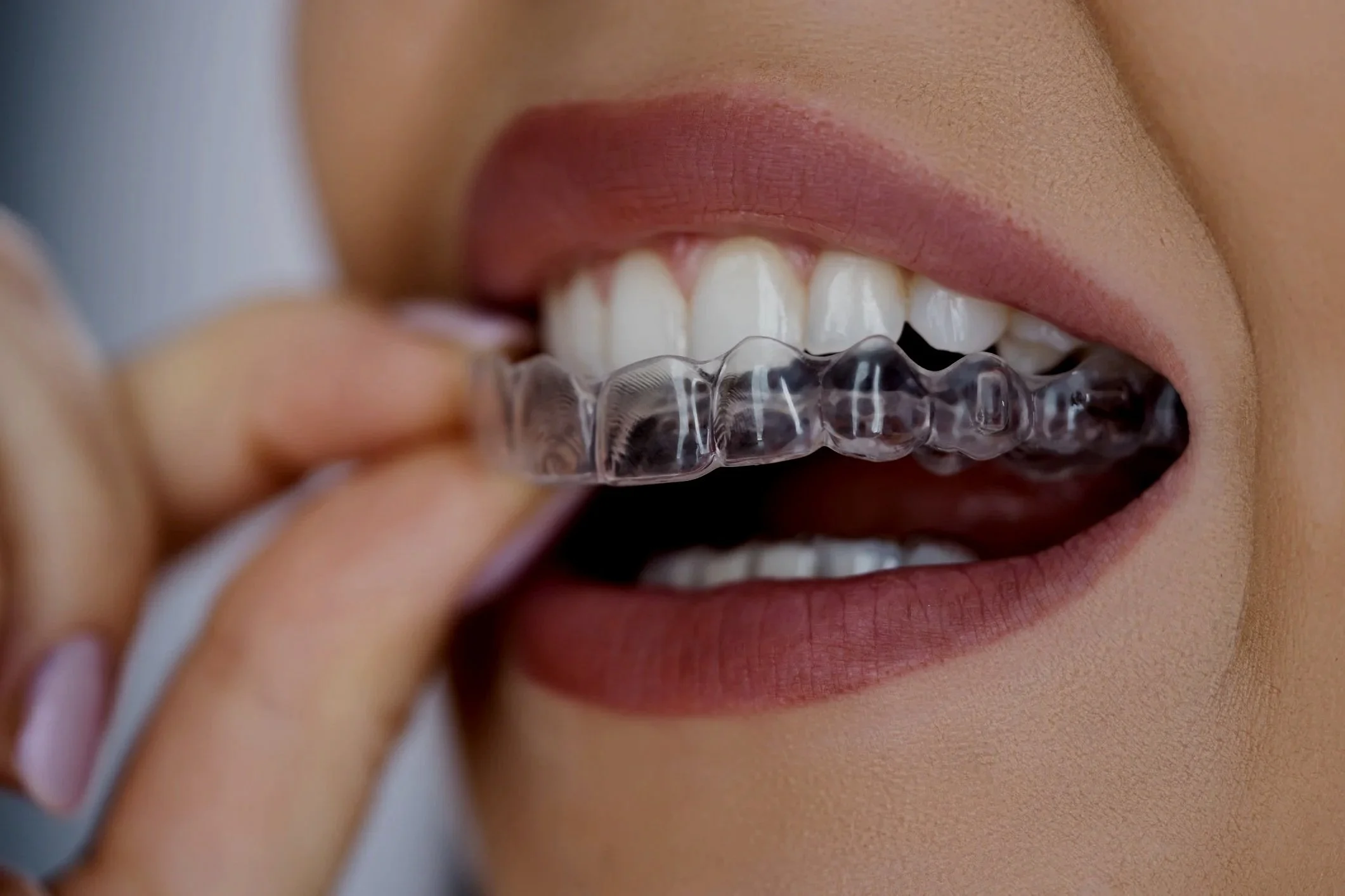 invisalign clear aligners.jpg