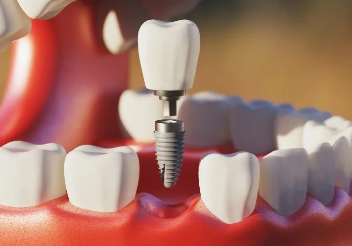Tooth Implantment