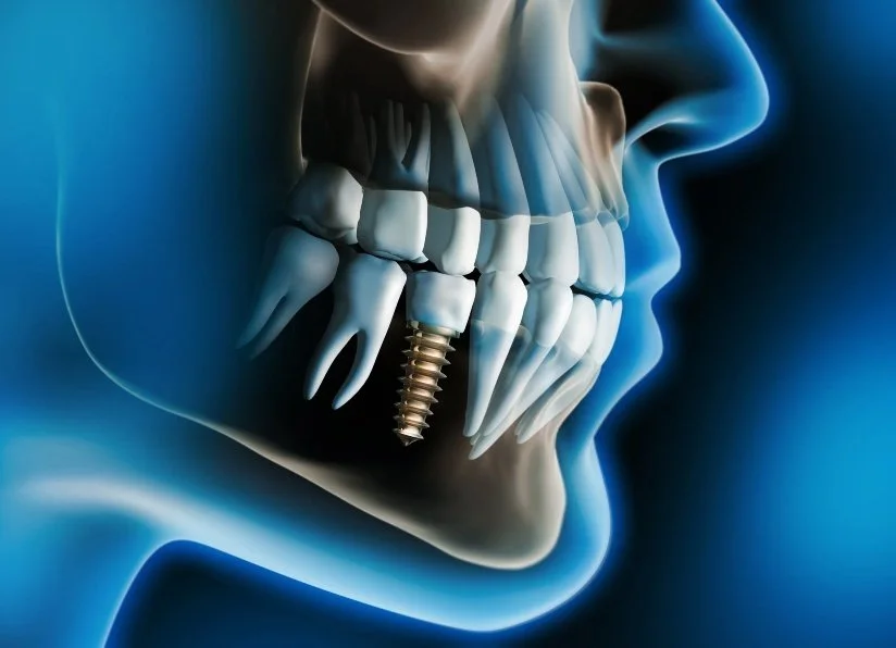 Dental Implant
