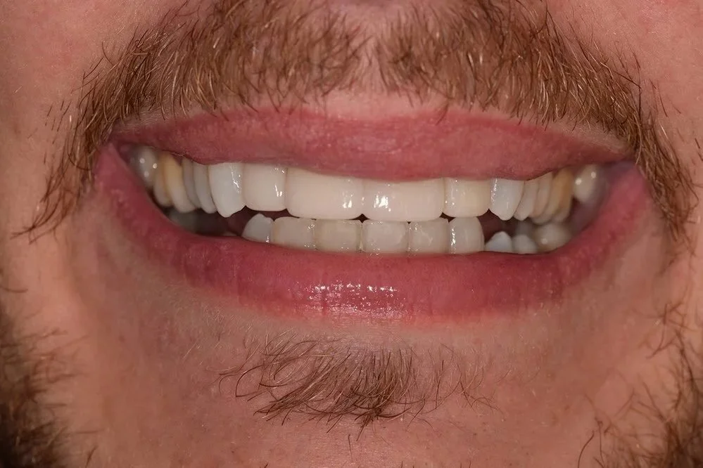 Type of brace that can straighten out your front teeth