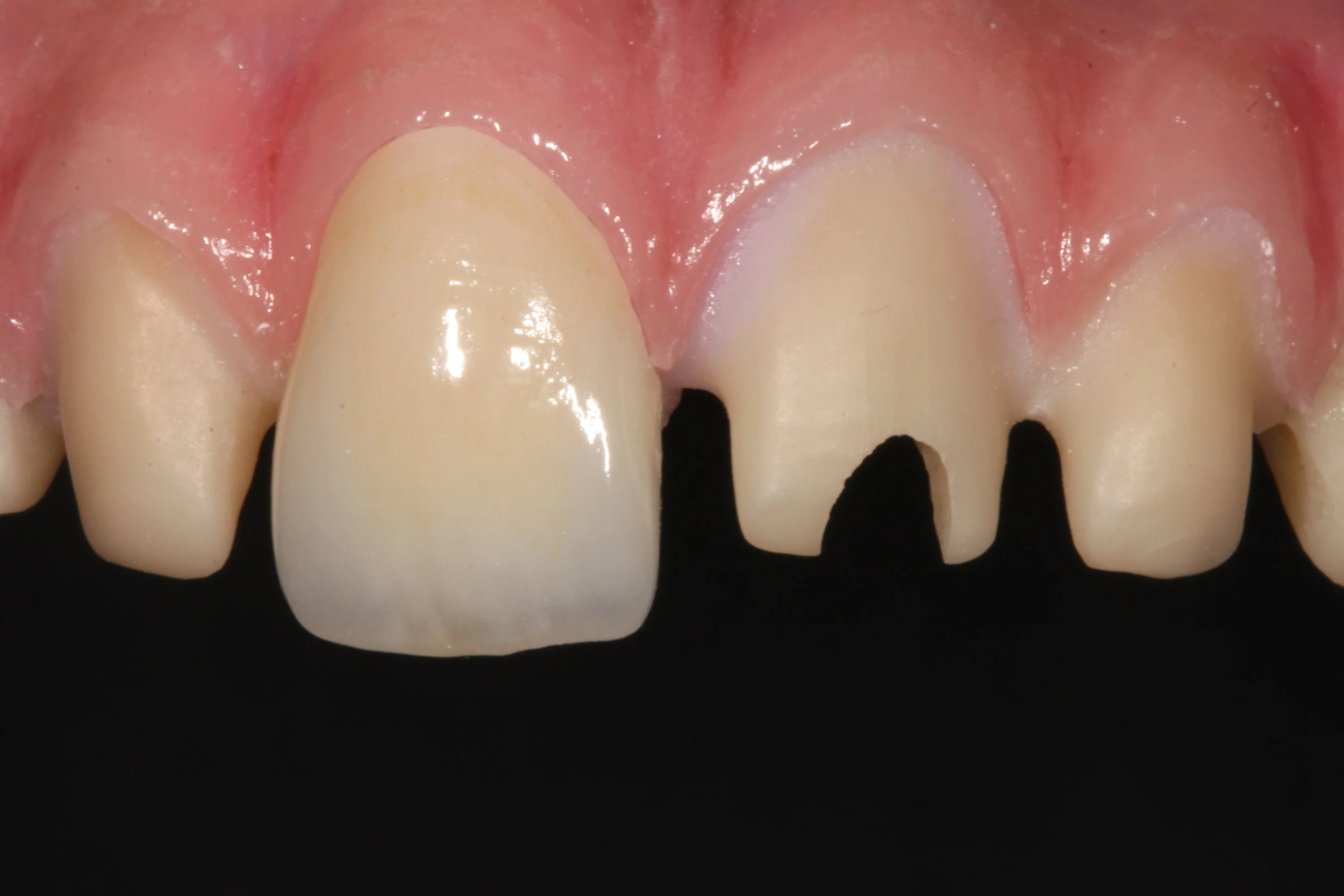 Implant restorations