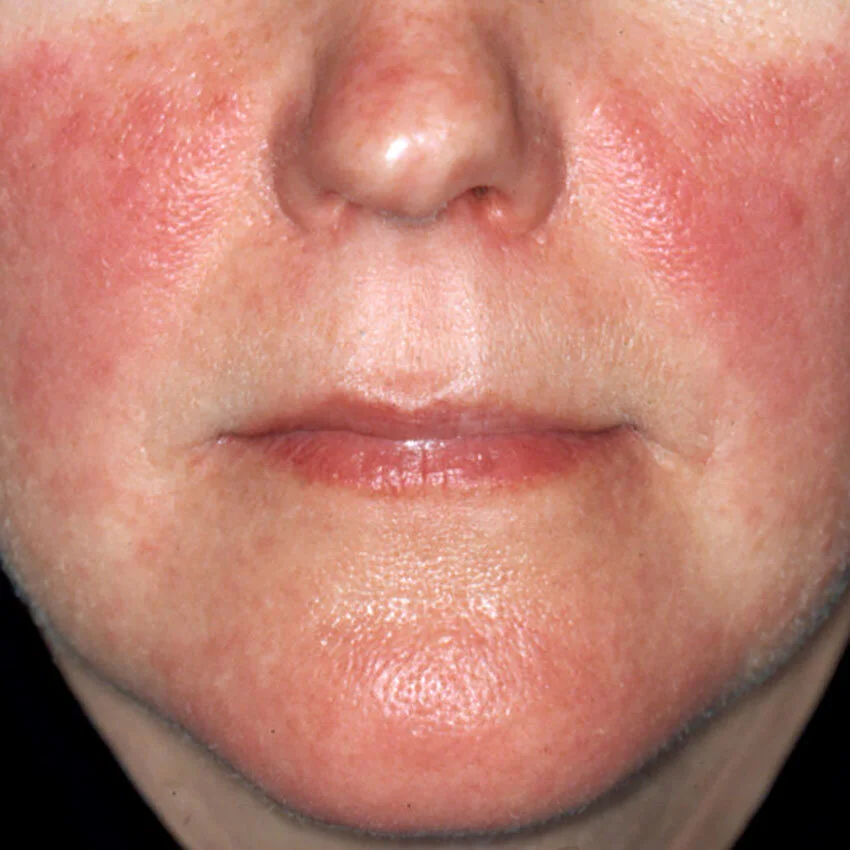 Colorado Rosacea Treatment