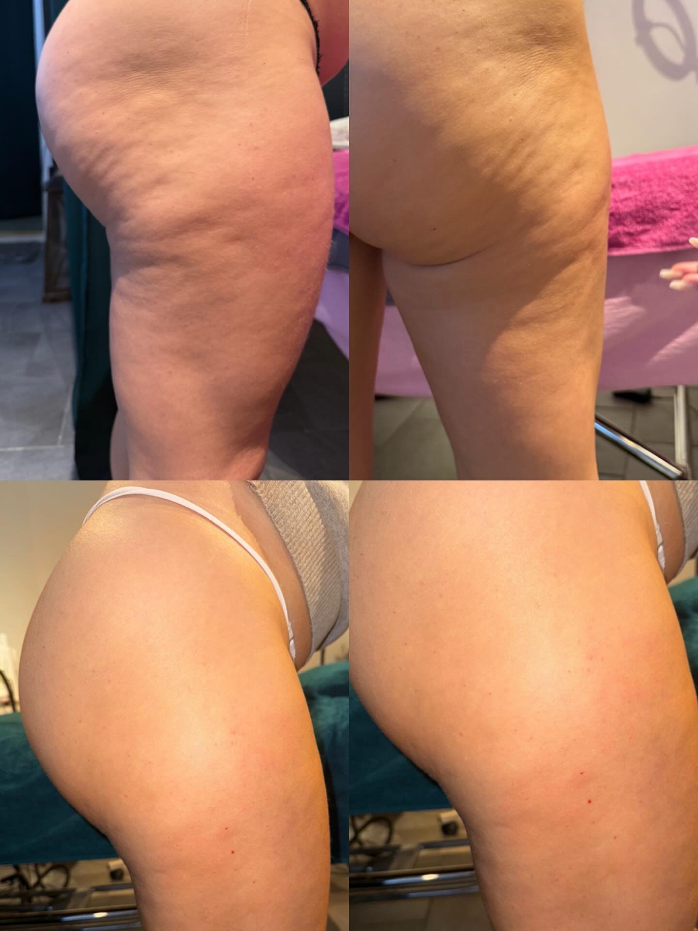 H&auml;r kommen en otrolig f&ouml;r och efter bild p&aring; en av v&aring;ra k&auml;ra kunder d&auml;r vi har behandlat hennes celluliter med hj&auml;lp av Carboxy terapi😍

Karboxyterapi &auml;r en behandling d&auml;r medicinskt ren koldioxid (CO₂) 