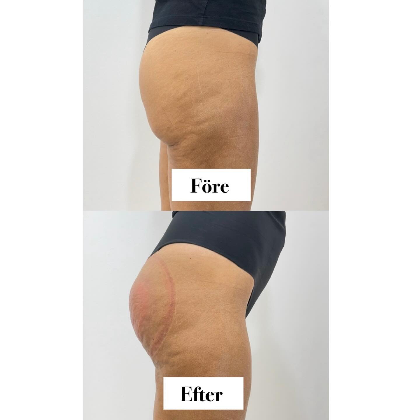 F&ouml;re ➝ Efter ✨

Ett naturligt rumplyft med Q Lift by Meco p&aring; Bluhme Clinic 🍑

Utan kirurgi, utan l&aring;ng &aring;terh&auml;mtning &ndash; men med tydlig skillnad.

Behandlingen ger mer lyft, fastare form och ett naturligt resultat som s