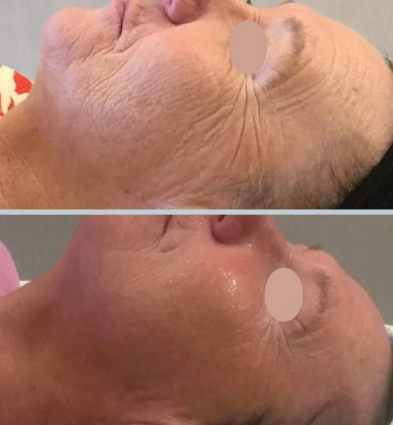 Mediceas Infuzion System &auml;r en n&aring;lfri ansiktsbehandling som hj&auml;lper huden att bli fastare, j&auml;mnare och mer &aring;terfuktad. Behandlingen fungerar genom att en apparat f&ouml;rs &ouml;ver huden samtidigt som den med hj&auml;lp av