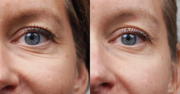 ✨ GLASS SKIN GLOW &Auml;R H&Auml;R ✨
Och nej&hellip; ni vill verkligen inte missa detta 😍

Vi p&aring;  Bluhme Clinic￼ har nu satt ihop en riktig dr&ouml;mcombo f&ouml;r huden &mdash; PRX-T33 + Lax-DNA Infuzion i en och samma behandling!💉

💧 🐟Lax