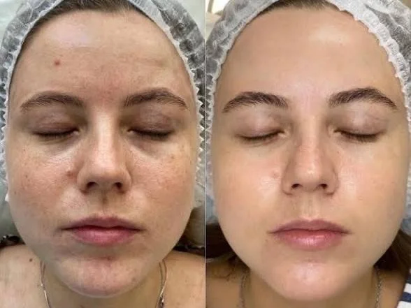 🙏🏻PRX-T33 KAMPANJ😍

Vill du ge huden mer lyster, sp&auml;nst och en j&auml;mnare k&auml;nsla? ✨

PRX-T33 &auml;r en hudf&ouml;ryngrande behandling som stimulerar kollagenproduktionen och hudens naturliga f&ouml;rnyelse. Resultatet kan bli fastare 