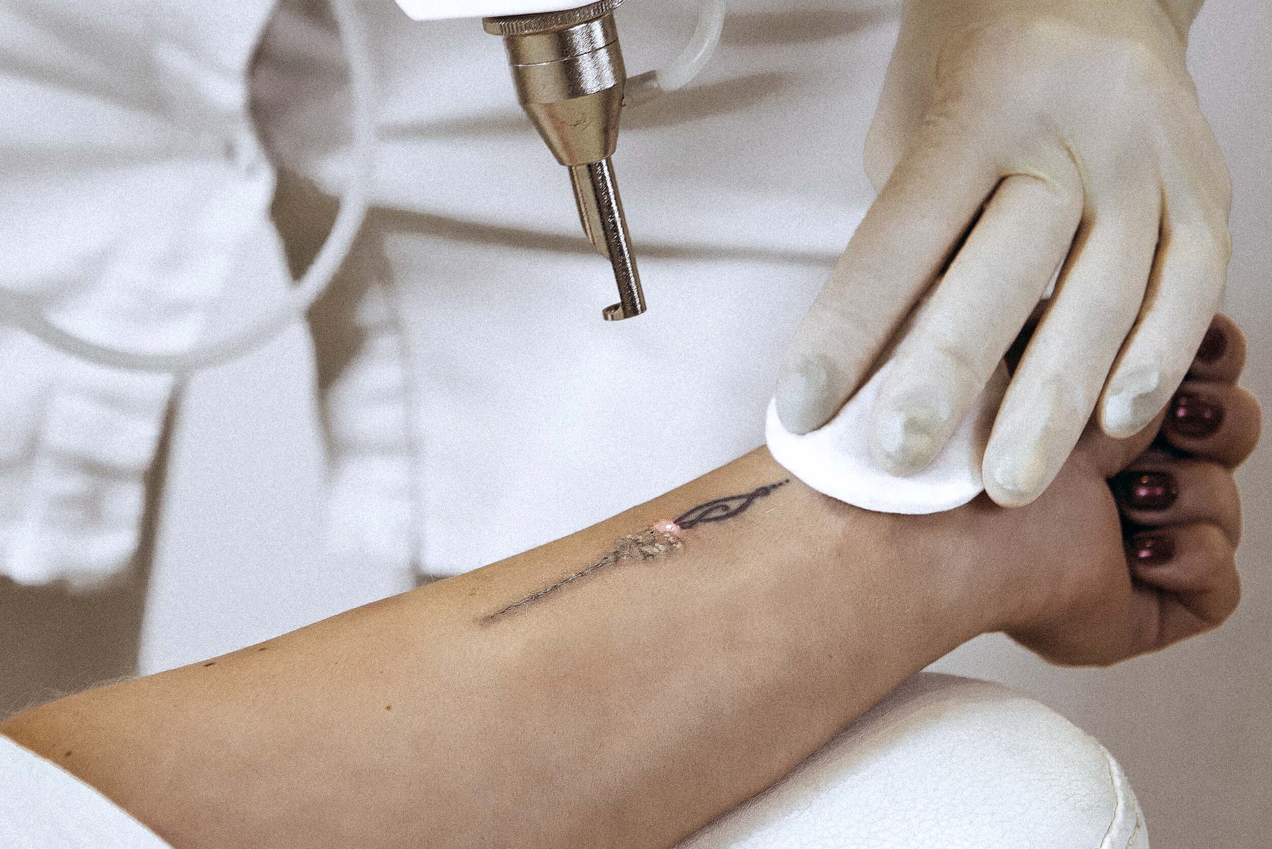 laser-tattoentfernung-rorschach.jpg