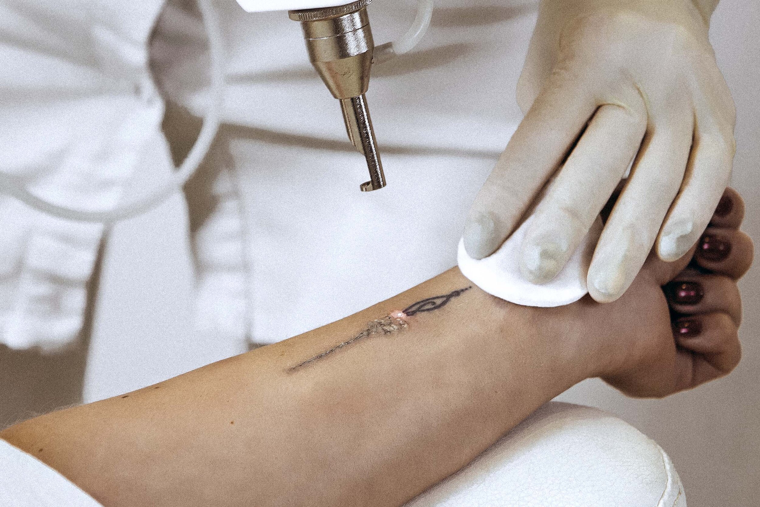 Tattoo-Entfernung mit Laser in Balingen 