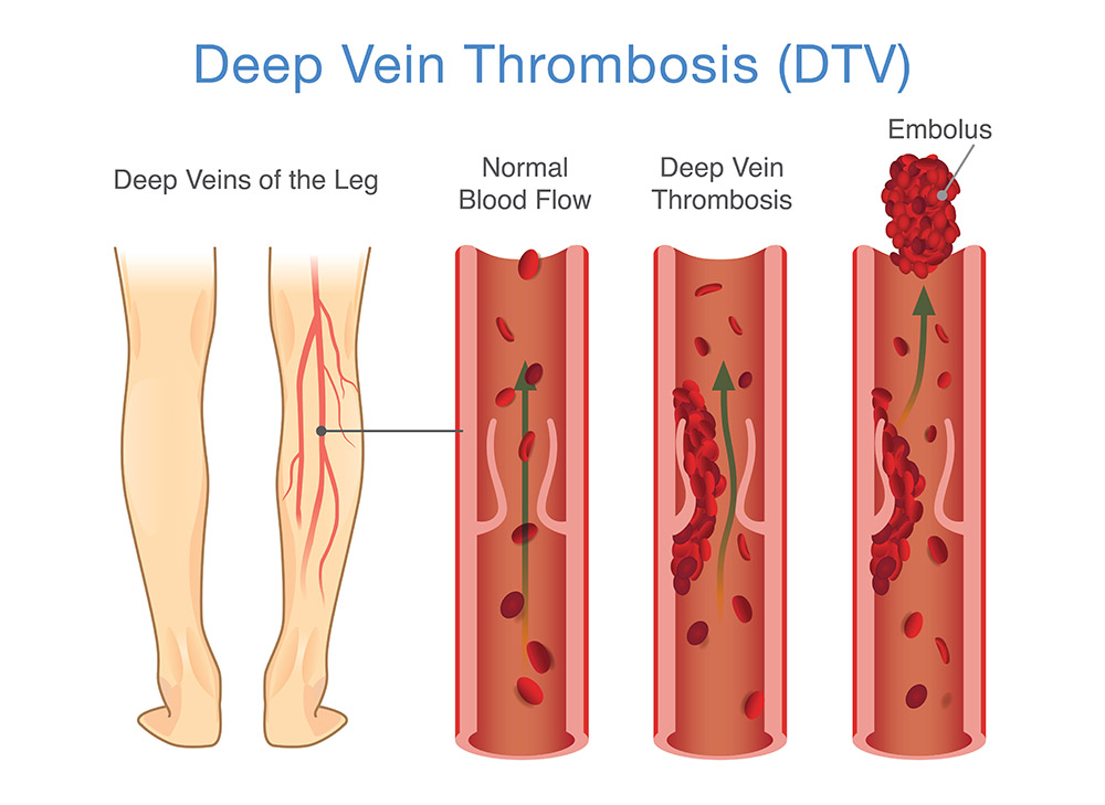 Deep vein thrombosis diagram