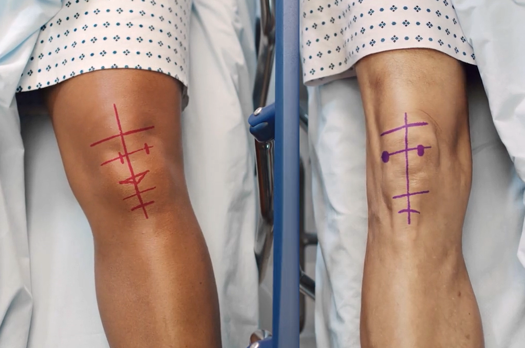 Conformis Knee Replacement.png