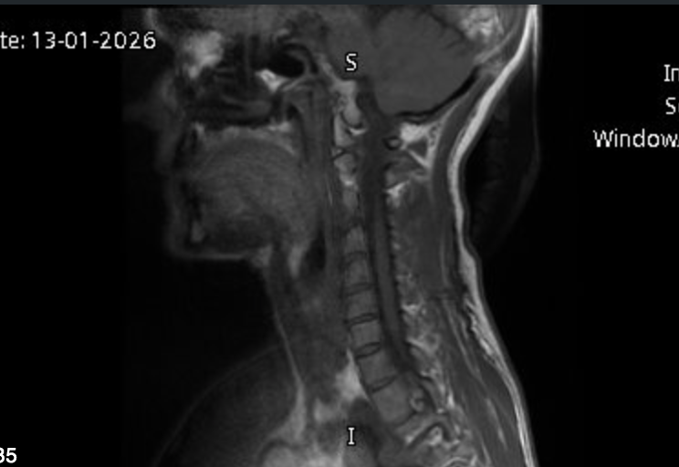 7 things I learned from a slipped (herniated) disc