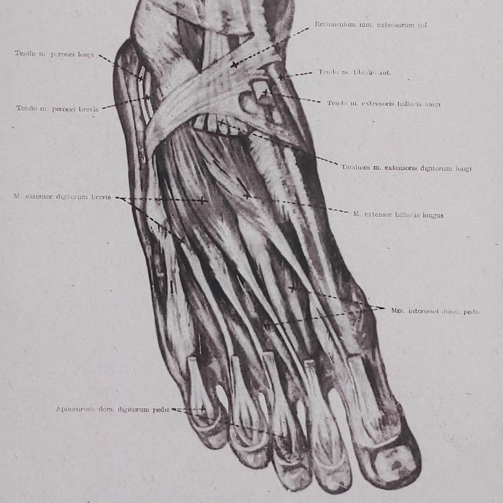 The Myofascial Release approach to plantar fasciitis