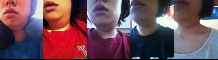 The Ranula Chronicles: The transoral approach