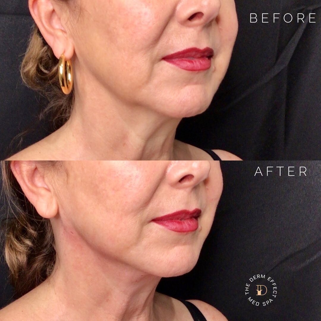 For this beautiful patient we used threads to lift her jowls and tighten her jawline and neck without surgery or downtime. She now has a smoother and more defined jawline and neck. Everything is very tight immediately after threads (as in these photo