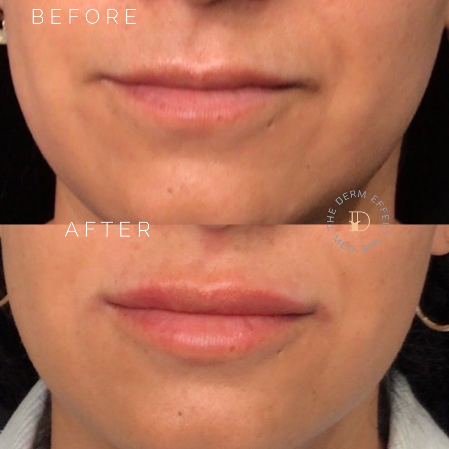 👄This beauty wanted to add volume so we focused the filler in her top lip and slightly filled her lower lip to complement, define, and add hydration. The result is a more feminine, youthful pout. We love!💖

___
Injections by: Mena Mesdaq, PA
Superv