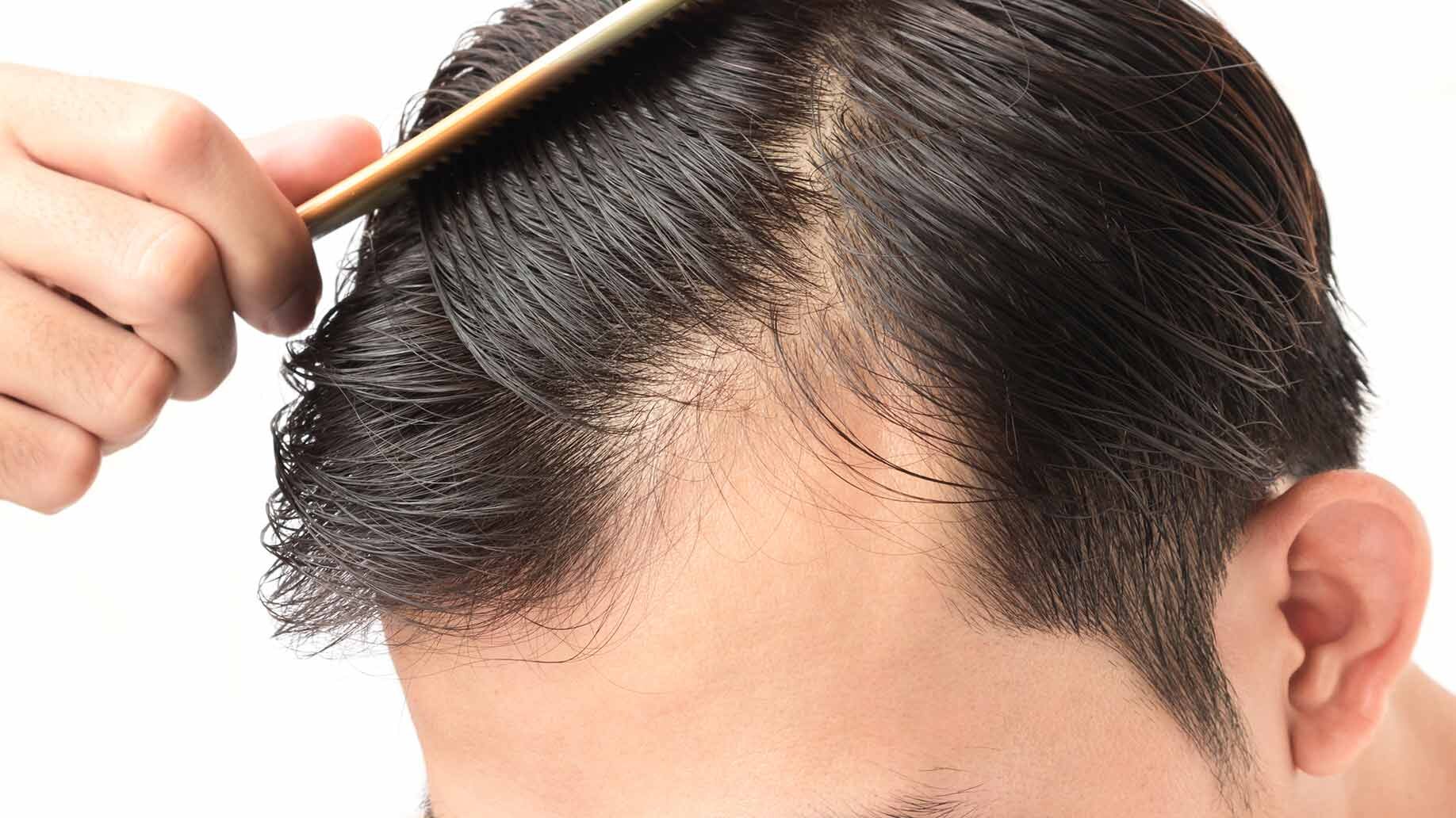 Hair Loss Treatment