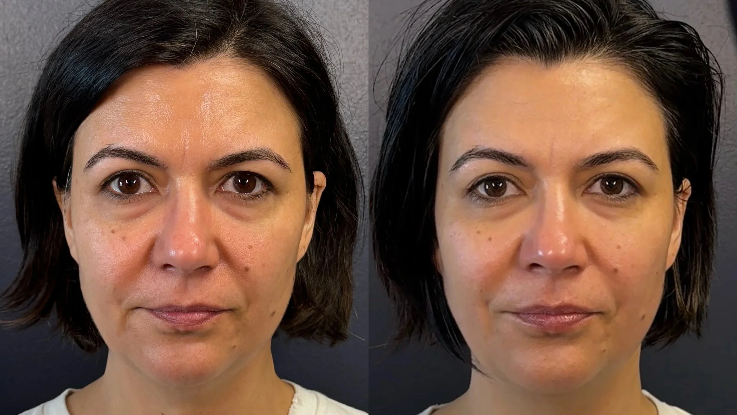 Comparison of before and after facial treatment showing woman with improved skin texture and tone.