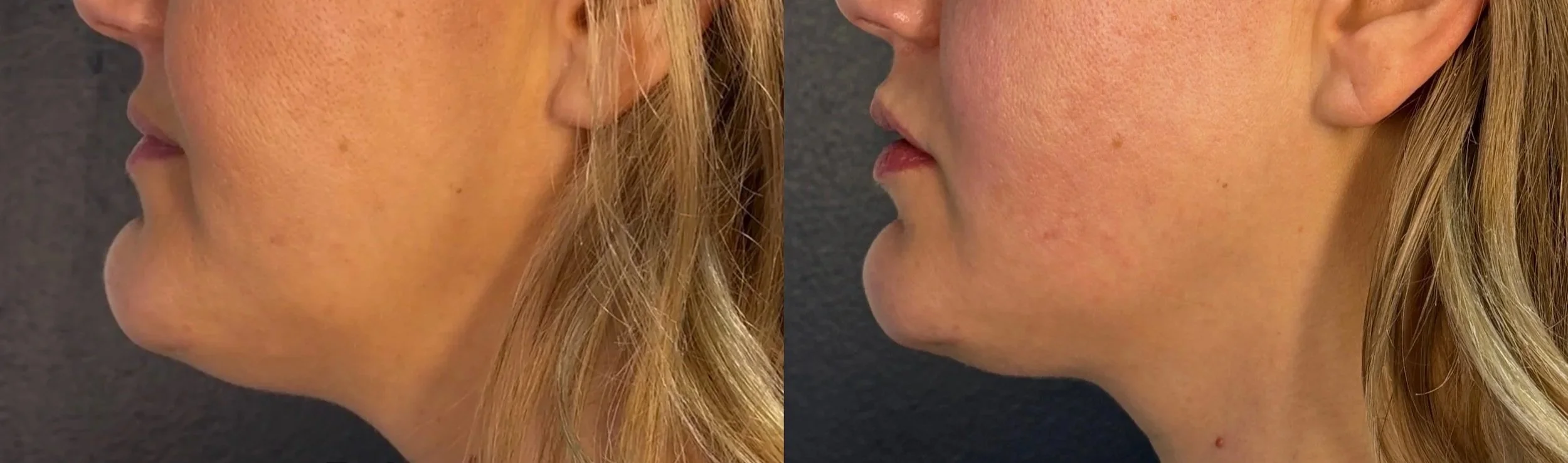 Side-by-side comparison of a woman's jawline, showing before and after images indicating a skincare treatment.