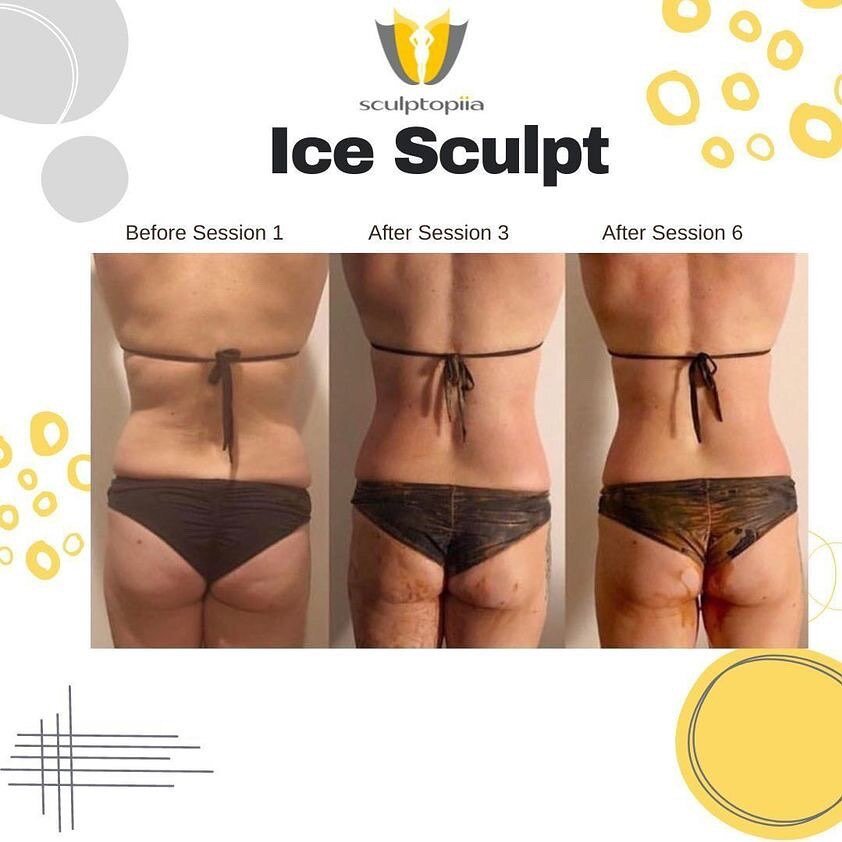 🟡 SCULPTOPIIA BODY !! ICE IS 
A REVOLUTIONARY ORGANIC WAY OF SCULPTING, TONING AND SLIMMING THE BODY.  THIS UNIQUE TREATMENT ACTIVATES A NATURAL PROCESSES IN THE BODY.

 ​THIS  UNIQUE COMBINATION OF SPECIALLY SELECTED ORGANIC HERBS, CLAYS AND RICH I