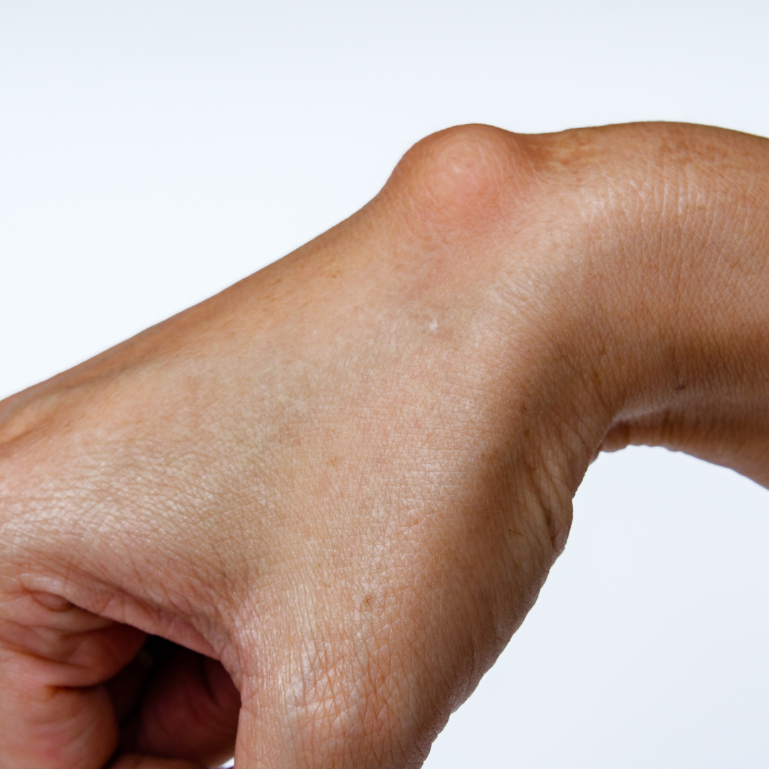 Ganglion Cyst Treatment — Hand in Hand Occupational Therapy of L.I., PLLC
