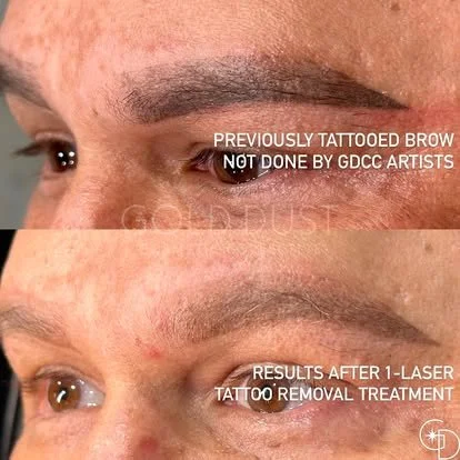 Laser Brow Removal4.jpg