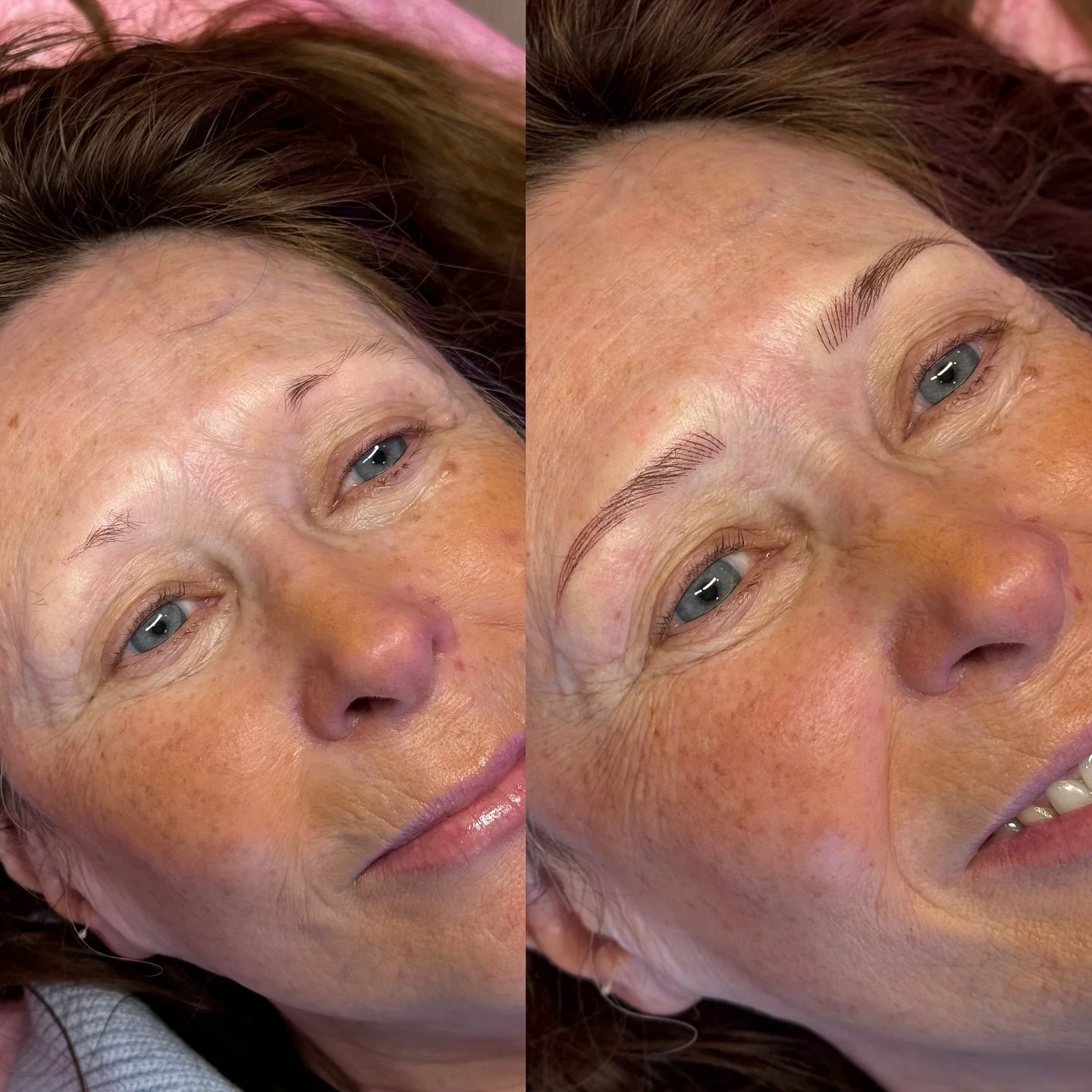 A natural nano brow transformation 🤌🏻😇🤩 just the right amount for her soft skin 
@injectingconfidence