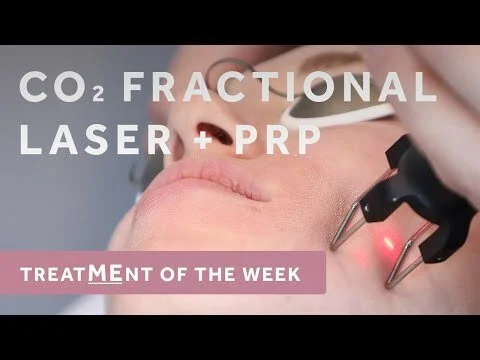 How-To Improve Skin Tone, Fine Lines, and Other Skin Issues with Fractional Resurfacing Laser & PRP
