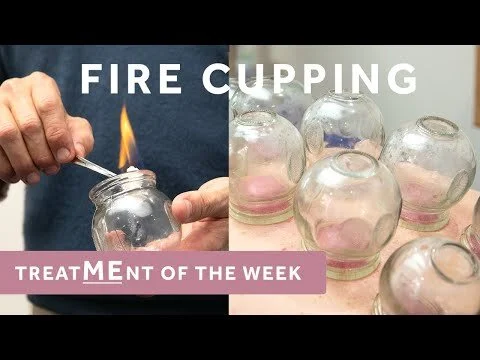 What is Fire Cupping Therapy? Watch the full treatment.