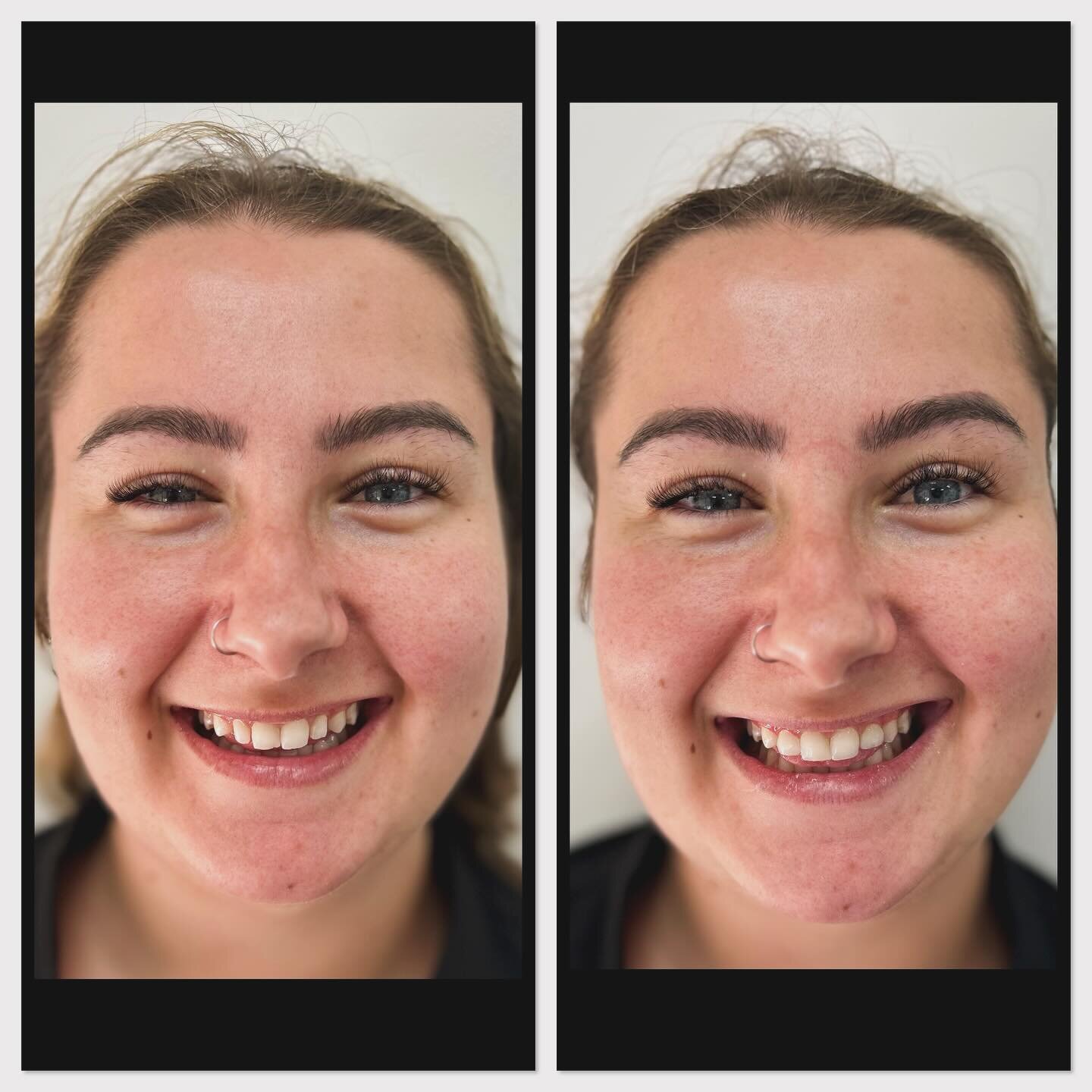 A natural, one visit smile enhancement for our beautiful dental assistant Shanni!

Dr Liz used resin to reduce the gaps between the teeth and create a more even smile. 🙌